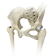 HIP SURGERY