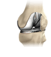 KNEE SURGERY